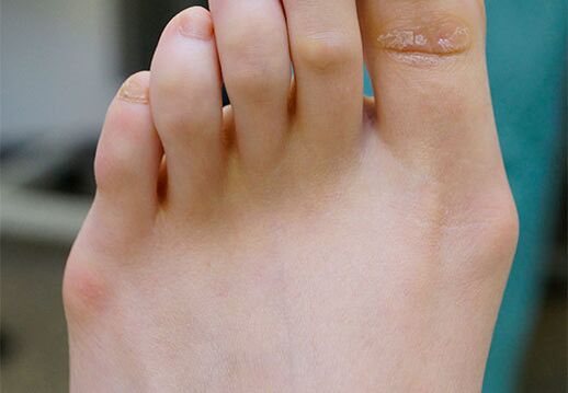 Valgus oina