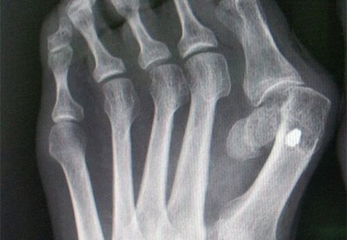 X -ray