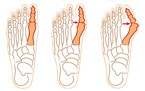 Hallux Valgus deformazioa