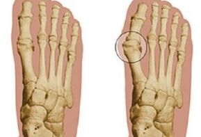 hallux valgus arrazoiak
