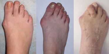 hallux valgus faseak