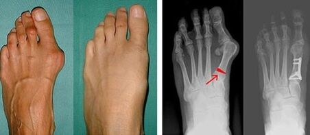 hallux valgus sintomak