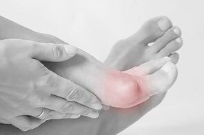 Hallux valgus nola aukeratu oinetakoak