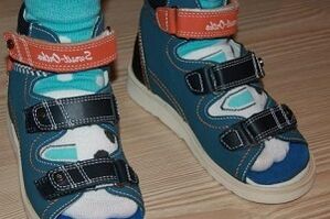 sandaliak jantzita hallux valgus haur batean