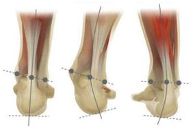 Oin normala, calcaneus-aren valgus eta varus desbideratzearekin
