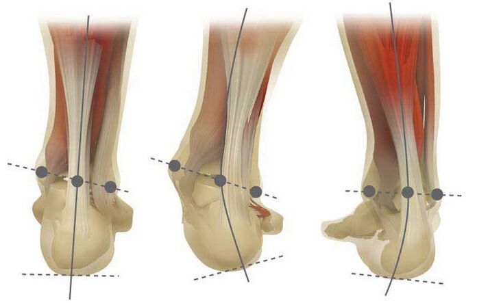 Valgus motak