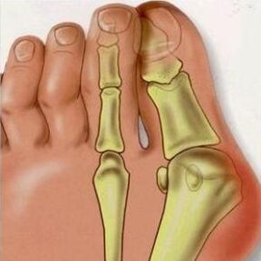 Valgus-en arrazoiak
