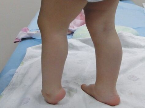 Valgus oinaren deformazioaren lehen sintomak