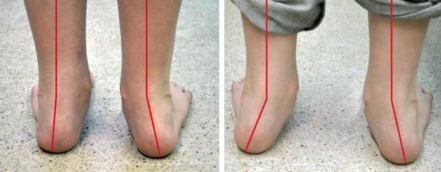 Valgus oina